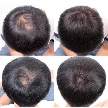 정수리 남자원픽 O형 커버 가발 부분 인모